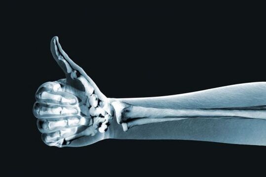 X-ray can help diagnose finger joint pain